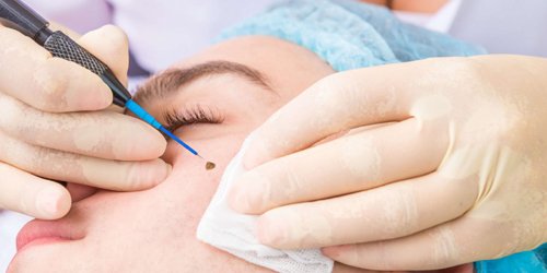 Laser Mole Removal